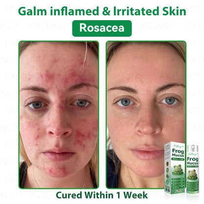 𝐹𝑎𝑡𝑜𝑛𝑔® 𝐹𝑟𝑜𝑔 𝑀𝑢𝑐𝑢𝑠 𝑆𝑘𝑖𝑛 𝑅𝑒𝑝𝑎𝑖𝑟 𝑆𝑝𝑟𝑎𝑦  – 💎 𝑈𝑙𝑡𝑟𝑎-𝑙𝑖𝑚𝑖𝑡𝑒𝑑 𝑑𝑒𝑎𝑙 𝑓𝑜𝑟 𝑠𝑒𝑙𝑒𝑐𝑡 𝑐𝑢𝑠𝑡𝑜𝑚𝑒𝑟𝑠 𝑜𝑛𝑙𝑦 🎁 𝐵𝑜𝑛𝑢𝑠 𝑡𝑟𝑎𝑣𝑒𝑙-𝑠𝑖𝑧𝑒 𝑔𝑖𝑓𝑡 + 𝐹𝑅𝐸𝐸 𝑒𝑥𝑝𝑟𝑒𝑠𝑠 𝑠ℎ𝑖𝑝𝑝𝑖𝑛𝑔 ✔️ 𝑇𝑟𝑦 𝑟𝑖𝑠𝑘-𝑓𝑟𝑒𝑒 𝑤𝑖𝑡ℎ 180-𝑑𝑎𝑦 𝑠𝑎𝑡𝑖𝑠𝑓𝑎𝑐𝑡𝑖𝑜𝑛 𝑔𝑢𝑎𝑟𝑎𝑛𝑡𝑒𝑒 ⏰ 𝐷𝑜𝑛’𝑡 𝑤𝑎𝑖𝑡 — 𝑡ℎ𝑖𝑠 𝑝𝑟𝑖𝑐𝑒 𝑚𝑎𝑦 𝑛𝑒𝑣𝑒𝑟 𝑐𝑜𝑚𝑒 𝑏𝑎𝑐𝑘!-🐸