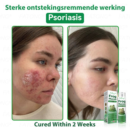 𝐹𝑎𝑡𝑜𝑛𝑔® 𝐹𝑟𝑜𝑔 𝑀𝑢𝑐𝑢𝑠 𝑆𝑘𝑖𝑛 𝑅𝑒𝑝𝑎𝑖𝑟 𝑆𝑝𝑟𝑎𝑦  – 💎 𝑈𝑙𝑡𝑟𝑎-𝑙𝑖𝑚𝑖𝑡𝑒𝑑 𝑑𝑒𝑎𝑙 𝑓𝑜𝑟 𝑠𝑒𝑙𝑒𝑐𝑡 𝑐𝑢𝑠𝑡𝑜𝑚𝑒𝑟𝑠 𝑜𝑛𝑙𝑦 🎁 𝐵𝑜𝑛𝑢𝑠 𝑡𝑟𝑎𝑣𝑒𝑙-𝑠𝑖𝑧𝑒 𝑔𝑖𝑓𝑡 + 𝐹𝑅𝐸𝐸 𝑒𝑥𝑝𝑟𝑒𝑠𝑠 𝑠ℎ𝑖𝑝𝑝𝑖𝑛𝑔 ✔️ 𝑇𝑟𝑦 𝑟𝑖𝑠𝑘-𝑓𝑟𝑒𝑒 𝑤𝑖𝑡ℎ 180-𝑑𝑎𝑦 𝑠𝑎𝑡𝑖𝑠𝑓𝑎𝑐𝑡𝑖𝑜𝑛 𝑔𝑢𝑎𝑟𝑎𝑛𝑡𝑒𝑒 ⏰ 𝐷𝑜𝑛’𝑡 𝑤𝑎𝑖𝑡 — 𝑡ℎ𝑖𝑠 𝑝𝑟𝑖𝑐𝑒 𝑚𝑎𝑦 𝑛𝑒𝑣𝑒𝑟 𝑐𝑜𝑚𝑒 𝑏𝑎𝑐𝑘!-🐸