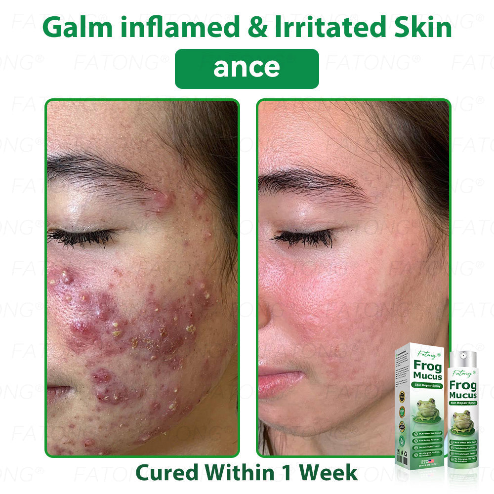 𝐹𝑎𝑡𝑜𝑛𝑔® 𝐹𝑟𝑜𝑔 𝑀𝑢𝑐𝑢𝑠 𝑆𝑘𝑖𝑛 𝑅𝑒𝑝𝑎𝑖𝑟 𝑆𝑝𝑟𝑎𝑦  – 💎 𝑈𝑙𝑡𝑟𝑎-𝑙𝑖𝑚𝑖𝑡𝑒𝑑 𝑑𝑒𝑎𝑙 𝑓𝑜𝑟 𝑠𝑒𝑙𝑒𝑐𝑡 𝑐𝑢𝑠𝑡𝑜𝑚𝑒𝑟𝑠 𝑜𝑛𝑙𝑦 🎁 𝐵𝑜𝑛𝑢𝑠 𝑡𝑟𝑎𝑣𝑒𝑙-𝑠𝑖𝑧𝑒 𝑔𝑖𝑓𝑡 + 𝐹𝑅𝐸𝐸 𝑒𝑥𝑝𝑟𝑒𝑠𝑠 𝑠ℎ𝑖𝑝𝑝𝑖𝑛𝑔 ✔️ 𝑇𝑟𝑦 𝑟𝑖𝑠𝑘-𝑓𝑟𝑒𝑒 𝑤𝑖𝑡ℎ 180-𝑑𝑎𝑦 𝑠𝑎𝑡𝑖𝑠𝑓𝑎𝑐𝑡𝑖𝑜𝑛 𝑔𝑢𝑎𝑟𝑎𝑛𝑡𝑒𝑒 ⏰ 𝐷𝑜𝑛’𝑡 𝑤𝑎𝑖𝑡 — 𝑡ℎ𝑖𝑠 𝑝𝑟𝑖𝑐𝑒 𝑚𝑎𝑦 𝑛𝑒𝑣𝑒𝑟 𝑐𝑜𝑚𝑒 𝑏𝑎𝑐𝑘!-🐸