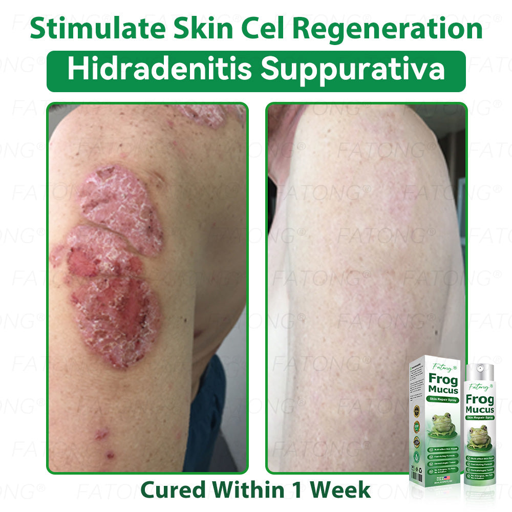 𝐹𝑎𝑡𝑜𝑛𝑔® 𝐹𝑟𝑜𝑔 𝑀𝑢𝑐𝑢𝑠 𝑆𝑘𝑖𝑛 𝑅𝑒𝑝𝑎𝑖𝑟 𝑆𝑝𝑟𝑎𝑦  – 💎 𝑈𝑙𝑡𝑟𝑎-𝑙𝑖𝑚𝑖𝑡𝑒𝑑 𝑑𝑒𝑎𝑙 𝑓𝑜𝑟 𝑠𝑒𝑙𝑒𝑐𝑡 𝑐𝑢𝑠𝑡𝑜𝑚𝑒𝑟𝑠 𝑜𝑛𝑙𝑦 🎁 𝐵𝑜𝑛𝑢𝑠 𝑡𝑟𝑎𝑣𝑒𝑙-𝑠𝑖𝑧𝑒 𝑔𝑖𝑓𝑡 + 𝐹𝑅𝐸𝐸 𝑒𝑥𝑝𝑟𝑒𝑠𝑠 𝑠ℎ𝑖𝑝𝑝𝑖𝑛𝑔 ✔️ 𝑇𝑟𝑦 𝑟𝑖𝑠𝑘-𝑓𝑟𝑒𝑒 𝑤𝑖𝑡ℎ 180-𝑑𝑎𝑦 𝑠𝑎𝑡𝑖𝑠𝑓𝑎𝑐𝑡𝑖𝑜𝑛 𝑔𝑢𝑎𝑟𝑎𝑛𝑡𝑒𝑒 ⏰ 𝐷𝑜𝑛’𝑡 𝑤𝑎𝑖𝑡 — 𝑡ℎ𝑖𝑠 𝑝𝑟𝑖𝑐𝑒 𝑚𝑎𝑦 𝑛𝑒𝑣𝑒𝑟 𝑐𝑜𝑚𝑒 𝑏𝑎𝑐𝑘!-🐸