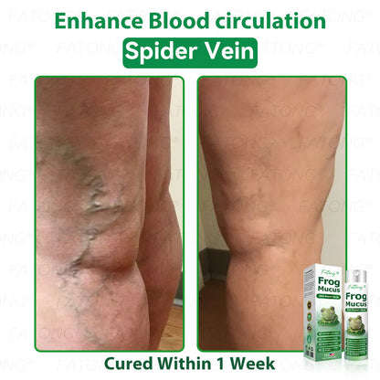 𝐹𝑎𝑡𝑜𝑛𝑔® 𝐹𝑟𝑜𝑔 𝑀𝑢𝑐𝑢𝑠 𝑆𝑘𝑖𝑛 𝑅𝑒𝑝𝑎𝑖𝑟 𝑆𝑝𝑟𝑎𝑦  – 💎 𝑈𝑙𝑡𝑟𝑎-𝑙𝑖𝑚𝑖𝑡𝑒𝑑 𝑑𝑒𝑎𝑙 𝑓𝑜𝑟 𝑠𝑒𝑙𝑒𝑐𝑡 𝑐𝑢𝑠𝑡𝑜𝑚𝑒𝑟𝑠 𝑜𝑛𝑙𝑦 🎁 𝐵𝑜𝑛𝑢𝑠 𝑡𝑟𝑎𝑣𝑒𝑙-𝑠𝑖𝑧𝑒 𝑔𝑖𝑓𝑡 + 𝐹𝑅𝐸𝐸 𝑒𝑥𝑝𝑟𝑒𝑠𝑠 𝑠ℎ𝑖𝑝𝑝𝑖𝑛𝑔 ✔️ 𝑇𝑟𝑦 𝑟𝑖𝑠𝑘-𝑓𝑟𝑒𝑒 𝑤𝑖𝑡ℎ 180-𝑑𝑎𝑦 𝑠𝑎𝑡𝑖𝑠𝑓𝑎𝑐𝑡𝑖𝑜𝑛 𝑔𝑢𝑎𝑟𝑎𝑛𝑡𝑒𝑒 ⏰ 𝐷𝑜𝑛’𝑡 𝑤𝑎𝑖𝑡 — 𝑡ℎ𝑖𝑠 𝑝𝑟𝑖𝑐𝑒 𝑚𝑎𝑦 𝑛𝑒𝑣𝑒𝑟 𝑐𝑜𝑚𝑒 𝑏𝑎𝑐𝑘!-🐸