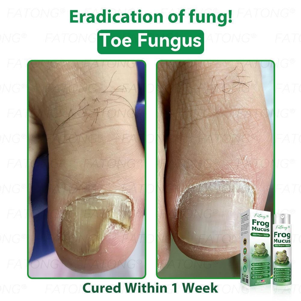 𝐹𝑎𝑡𝑜𝑛𝑔® 𝐹𝑟𝑜𝑔 𝑀𝑢𝑐𝑢𝑠 𝑆𝑘𝑖𝑛 𝑅𝑒𝑝𝑎𝑖𝑟 𝑆𝑝𝑟𝑎𝑦  – 💎 𝑈𝑙𝑡𝑟𝑎-𝑙𝑖𝑚𝑖𝑡𝑒𝑑 𝑑𝑒𝑎𝑙 𝑓𝑜𝑟 𝑠𝑒𝑙𝑒𝑐𝑡 𝑐𝑢𝑠𝑡𝑜𝑚𝑒𝑟𝑠 𝑜𝑛𝑙𝑦 🎁 𝐵𝑜𝑛𝑢𝑠 𝑡𝑟𝑎𝑣𝑒𝑙-𝑠𝑖𝑧𝑒 𝑔𝑖𝑓𝑡 + 𝐹𝑅𝐸𝐸 𝑒𝑥𝑝𝑟𝑒𝑠𝑠 𝑠ℎ𝑖𝑝𝑝𝑖𝑛𝑔 ✔️ 𝑇𝑟𝑦 𝑟𝑖𝑠𝑘-𝑓𝑟𝑒𝑒 𝑤𝑖𝑡ℎ 180-𝑑𝑎𝑦 𝑠𝑎𝑡𝑖𝑠𝑓𝑎𝑐𝑡𝑖𝑜𝑛 𝑔𝑢𝑎𝑟𝑎𝑛𝑡𝑒𝑒 ⏰ 𝐷𝑜𝑛’𝑡 𝑤𝑎𝑖𝑡 — 𝑡ℎ𝑖𝑠 𝑝𝑟𝑖𝑐𝑒 𝑚𝑎𝑦 𝑛𝑒𝑣𝑒𝑟 𝑐𝑜𝑚𝑒 𝑏𝑎𝑐𝑘!-🐸