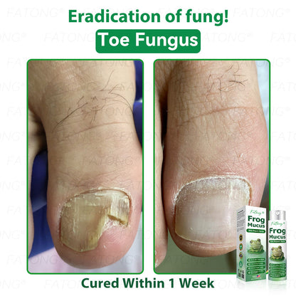 𝐹𝑎𝑡𝑜𝑛𝑔® 𝐹𝑟𝑜𝑔 𝑀𝑢𝑐𝑢𝑠 𝑆𝑘𝑖𝑛 𝑅𝑒𝑝𝑎𝑖𝑟 𝑆𝑝𝑟𝑎𝑦  – 💎 𝑈𝑙𝑡𝑟𝑎-𝑙𝑖𝑚𝑖𝑡𝑒𝑑 𝑑𝑒𝑎𝑙 𝑓𝑜𝑟 𝑠𝑒𝑙𝑒𝑐𝑡 𝑐𝑢𝑠𝑡𝑜𝑚𝑒𝑟𝑠 𝑜𝑛𝑙𝑦 🎁 𝐵𝑜𝑛𝑢𝑠 𝑡𝑟𝑎𝑣𝑒𝑙-𝑠𝑖𝑧𝑒 𝑔𝑖𝑓𝑡 + 𝐹𝑅𝐸𝐸 𝑒𝑥𝑝𝑟𝑒𝑠𝑠 𝑠ℎ𝑖𝑝𝑝𝑖𝑛𝑔 ✔️ 𝑇𝑟𝑦 𝑟𝑖𝑠𝑘-𝑓𝑟𝑒𝑒 𝑤𝑖𝑡ℎ 180-𝑑𝑎𝑦 𝑠𝑎𝑡𝑖𝑠𝑓𝑎𝑐𝑡𝑖𝑜𝑛 𝑔𝑢𝑎𝑟𝑎𝑛𝑡𝑒𝑒 ⏰ 𝐷𝑜𝑛’𝑡 𝑤𝑎𝑖𝑡 — 𝑡ℎ𝑖𝑠 𝑝𝑟𝑖𝑐𝑒 𝑚𝑎𝑦 𝑛𝑒𝑣𝑒𝑟 𝑐𝑜𝑚𝑒 𝑏𝑎𝑐𝑘!-🐸