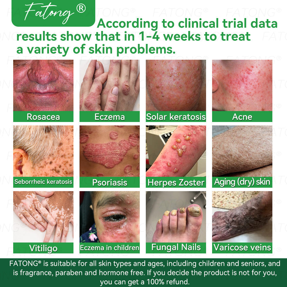 𝐹𝑎𝑡𝑜𝑛𝑔® 𝐹𝑟𝑜𝑔 𝑀𝑢𝑐𝑢𝑠 𝑆𝑘𝑖𝑛 𝑅𝑒𝑝𝑎𝑖𝑟 𝑆𝑝𝑟𝑎𝑦  – 💎 𝑈𝑙𝑡𝑟𝑎-𝑙𝑖𝑚𝑖𝑡𝑒𝑑 𝑑𝑒𝑎𝑙 𝑓𝑜𝑟 𝑠𝑒𝑙𝑒𝑐𝑡 𝑐𝑢𝑠𝑡𝑜𝑚𝑒𝑟𝑠 𝑜𝑛𝑙𝑦 🎁 𝐵𝑜𝑛𝑢𝑠 𝑡𝑟𝑎𝑣𝑒𝑙-𝑠𝑖𝑧𝑒 𝑔𝑖𝑓𝑡 + 𝐹𝑅𝐸𝐸 𝑒𝑥𝑝𝑟𝑒𝑠𝑠 𝑠ℎ𝑖𝑝𝑝𝑖𝑛𝑔 ✔️ 𝑇𝑟𝑦 𝑟𝑖𝑠𝑘-𝑓𝑟𝑒𝑒 𝑤𝑖𝑡ℎ 180-𝑑𝑎𝑦 𝑠𝑎𝑡𝑖𝑠𝑓𝑎𝑐𝑡𝑖𝑜𝑛 𝑔𝑢𝑎𝑟𝑎𝑛𝑡𝑒𝑒 ⏰ 𝐷𝑜𝑛’𝑡 𝑤𝑎𝑖𝑡 — 𝑡ℎ𝑖𝑠 𝑝𝑟𝑖𝑐𝑒 𝑚𝑎𝑦 𝑛𝑒𝑣𝑒𝑟 𝑐𝑜𝑚𝑒 𝑏𝑎𝑐𝑘!-🐸