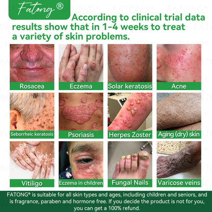 𝐹𝑎𝑡𝑜𝑛𝑔® 𝐹𝑟𝑜𝑔 𝑀𝑢𝑐𝑢𝑠 𝑆𝑘𝑖𝑛 𝑅𝑒𝑝𝑎𝑖𝑟 𝑆𝑝𝑟𝑎𝑦  – 💎 𝑈𝑙𝑡𝑟𝑎-𝑙𝑖𝑚𝑖𝑡𝑒𝑑 𝑑𝑒𝑎𝑙 𝑓𝑜𝑟 𝑠𝑒𝑙𝑒𝑐𝑡 𝑐𝑢𝑠𝑡𝑜𝑚𝑒𝑟𝑠 𝑜𝑛𝑙𝑦 🎁 𝐵𝑜𝑛𝑢𝑠 𝑡𝑟𝑎𝑣𝑒𝑙-𝑠𝑖𝑧𝑒 𝑔𝑖𝑓𝑡 + 𝐹𝑅𝐸𝐸 𝑒𝑥𝑝𝑟𝑒𝑠𝑠 𝑠ℎ𝑖𝑝𝑝𝑖𝑛𝑔 ✔️ 𝑇𝑟𝑦 𝑟𝑖𝑠𝑘-𝑓𝑟𝑒𝑒 𝑤𝑖𝑡ℎ 180-𝑑𝑎𝑦 𝑠𝑎𝑡𝑖𝑠𝑓𝑎𝑐𝑡𝑖𝑜𝑛 𝑔𝑢𝑎𝑟𝑎𝑛𝑡𝑒𝑒 ⏰ 𝐷𝑜𝑛’𝑡 𝑤𝑎𝑖𝑡 — 𝑡ℎ𝑖𝑠 𝑝𝑟𝑖𝑐𝑒 𝑚𝑎𝑦 𝑛𝑒𝑣𝑒𝑟 𝑐𝑜𝑚𝑒 𝑏𝑎𝑐𝑘!-🐸